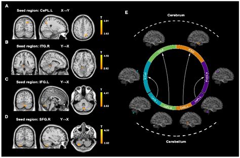 Brain Sciences Free Full Text Altered Cerebro Cerebellar Effective