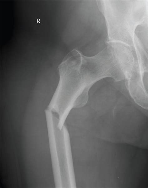 Subtrochanteric Fracture In The Same Patient As Figures Open I