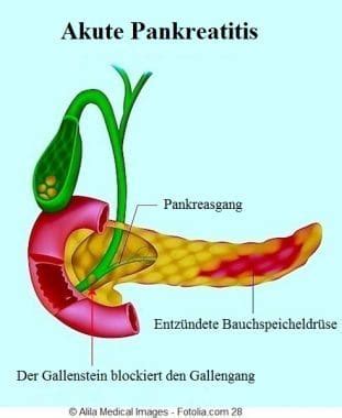 Akute und chronische Pankreatitis Symptome Pankreas Diät Ursachen