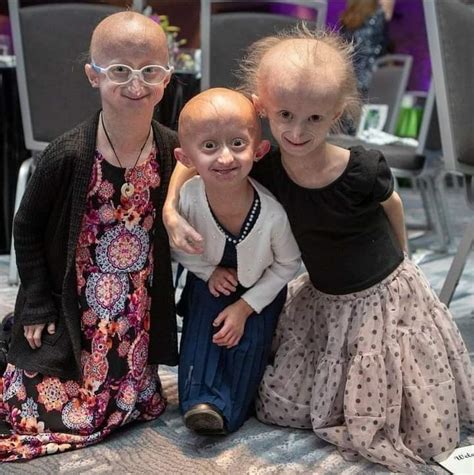 Somos Cosmos on Twitter Progeria Es una rara enfermedad genética