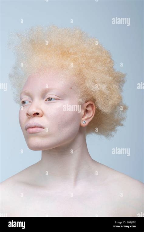 Dravidian Albino People