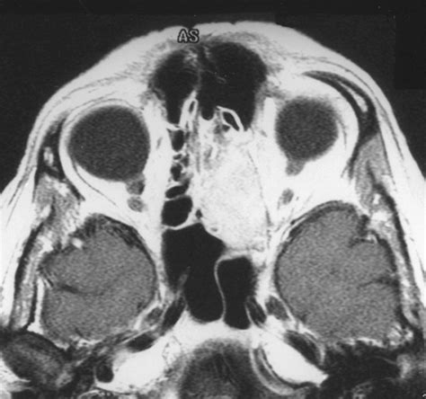 Fibrous Dysplasia Skull Bone Scan