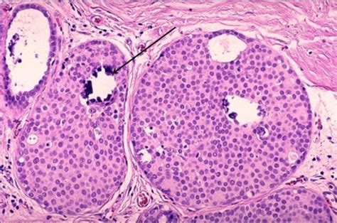 Breast Cytopathology Ii Flashcards Quizlet