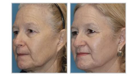 Halo Hybrid Fractional Skin Resurfacing Laser Blue Harbor Dermatology