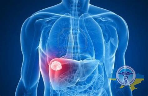 Treatment of liver metastases abroad: modern methods, cost