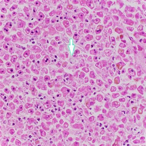 Photomicrograph Of The Liver With Rare Foamy Histiocyte Arrow In