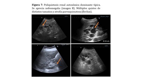 Ecograf A En La Enfermedad Renal Nefrolog A Al D A