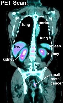 Colon And Rectal CT And PET Scans