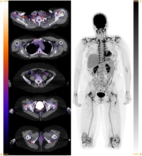 Role Of 18F FDG PET CT In Large Vessel Vasculitis And Polymyalgia