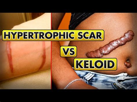 Hypertrophic Scar Vs Keloid