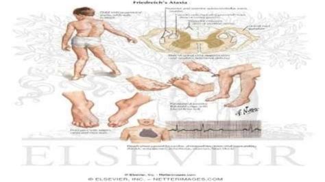 Approach to a patient of spastic paraplegia