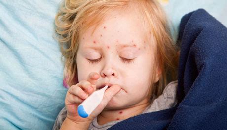 Why can a red rash, fever, and sore throat be symptoms of measles ...