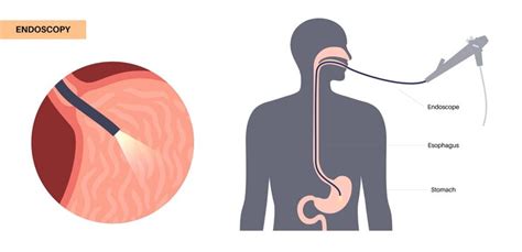 Premium Vector | Gastroscopy procedure gastroenterologist uses a ...