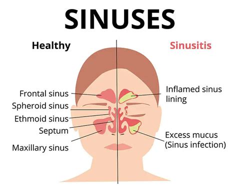 Sphenoid Sinus Disease Symptoms Captions Ideas