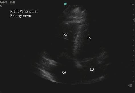 McConnell's Sign - a finding specific for Pulmonary Embolus｜Emory ...