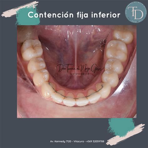 Contención fija en Ortodoncia