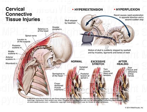 Whiplash Injury Of The Cervical Spine Stock Trial 42 OFF