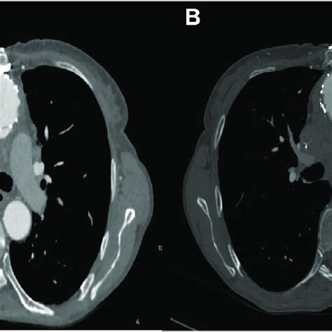 A Computed Tomography Ct Angiogram Demonstrating Recurrent