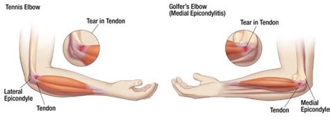 Peak Ergonomics | *Healthy Elbow Solutions: Tennis & Golfer’s Elbow Prevention & First Aid ...