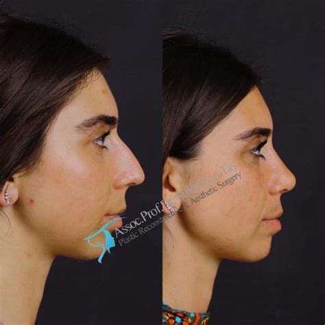 Rhinoplasty Gallery Assoc Prof Dr Suleyman TAS Rhinoplasty