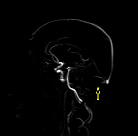 Bilateral Transverse Sinus Stenosis Causing Intracranial Hypertension