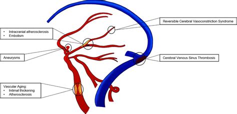 Cerebrovascular Disease In Women Aditya Kumar Louise Mccullough 2021