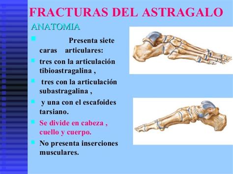 18 Fractura Astragalo Calcaneo