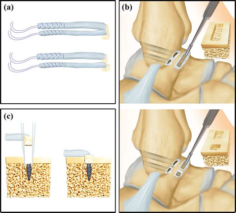 Anatomic Reconstruction Of Anterior Talofibular Ligament