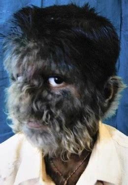 Hypertrichosis - Pictures, Symptoms, Causes and Treatment