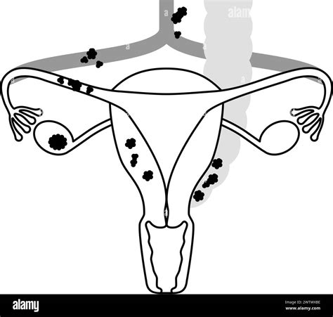 Diagrammatic Illustration Of Stage Iii Ovarian Cancer Anatomy Of The