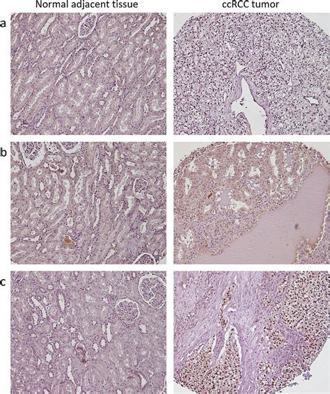 Ps Stat Location Patterns In Ccrcc Tumors Representative Images Of