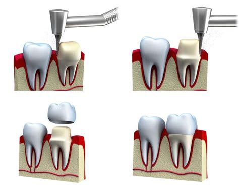 Crowns Kids World Pediatric Dentistry San Antonio Tx