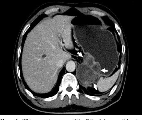 Figure 1 From A Case Of Adenocarcinoma Arising Within Intra Abdominal