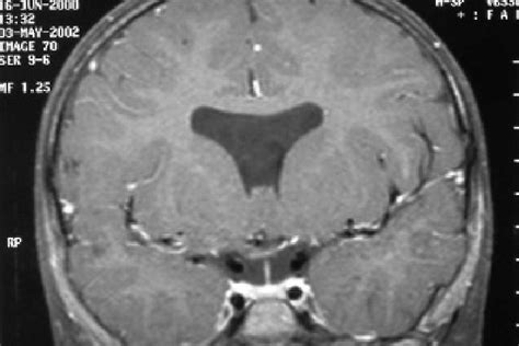 Absent Septum Pellucidum In A Patient With Septo Optic Dysplasia De