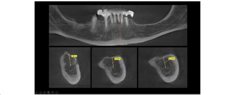 Cbct Scan Before Surgery A Panoramic And Cross Sectional View