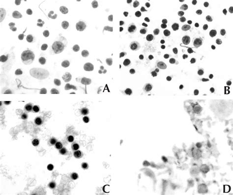 Figure 1 from Cytologic Features of NK/T-Cell Lymphoma | Semantic Scholar