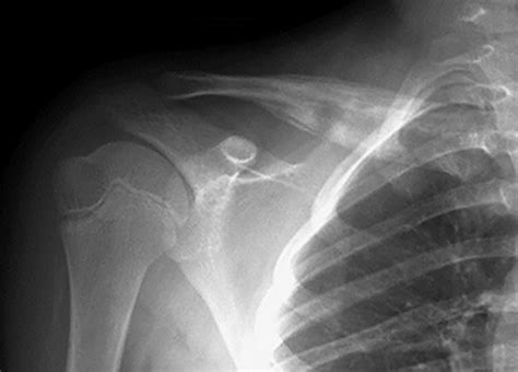 Chronic Recurrent Multifocal Osteomyelitis Radsource