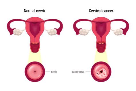 70 Cervical Dysplasia Stock Illustrations Royalty Free Vector