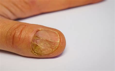 Nail Patella Syndrome Genetic Anomalies In Nails Bones