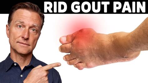 Say Goodbye To Gout The 1 Best Protocol Revealed