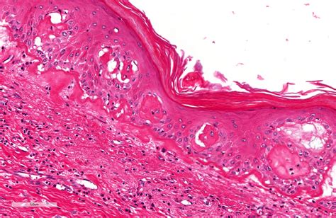 Balanitis Xerotica Obliterans Histology