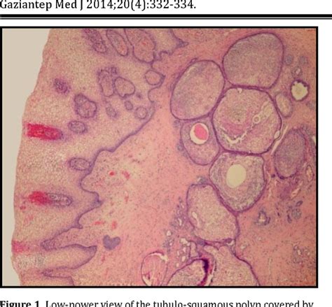 Figure 1 From A Rare Lesion Of The Vagina Tubulo Squamous Polyp