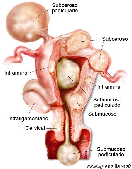 Mioma uterino no es cáncer Matrona Brunis