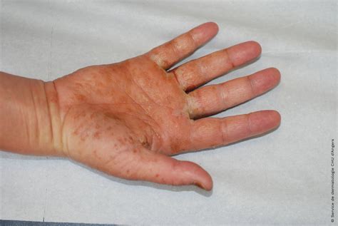 Eczema On Back Of Hands