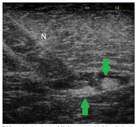 Figure 2 From Ultrasound Guided Psoas Compartment And Sciatic Nerve