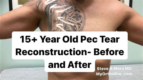 Can An Old Pec Major Tear Be Repaired Moramd Youtube