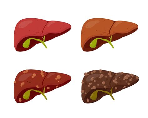 Premium Vector | Stages of liver disease leading to cirrhosis