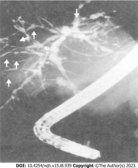 Liver Transplant In Primary Sclerosing Cholangitis Current Trends And Future Directions