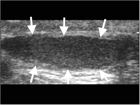 Ultrasound of the Inguinal Canal – Part II - myCME