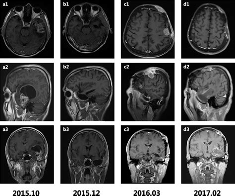 T Weighted Gadolinium Enhanced Axial Sagittal And Coronal Magnetic